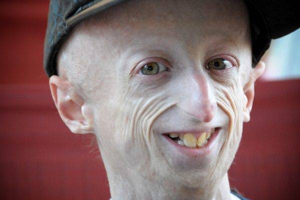 Progeria, Sammy Basso operato al cuore: "Adesso me la gioco tutta"