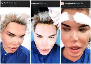 Rodrigo Alves irriconoscibile, ennesimo intervento: 7 ore in sala operatoria, ecco cosa ha cambiato - FOTO