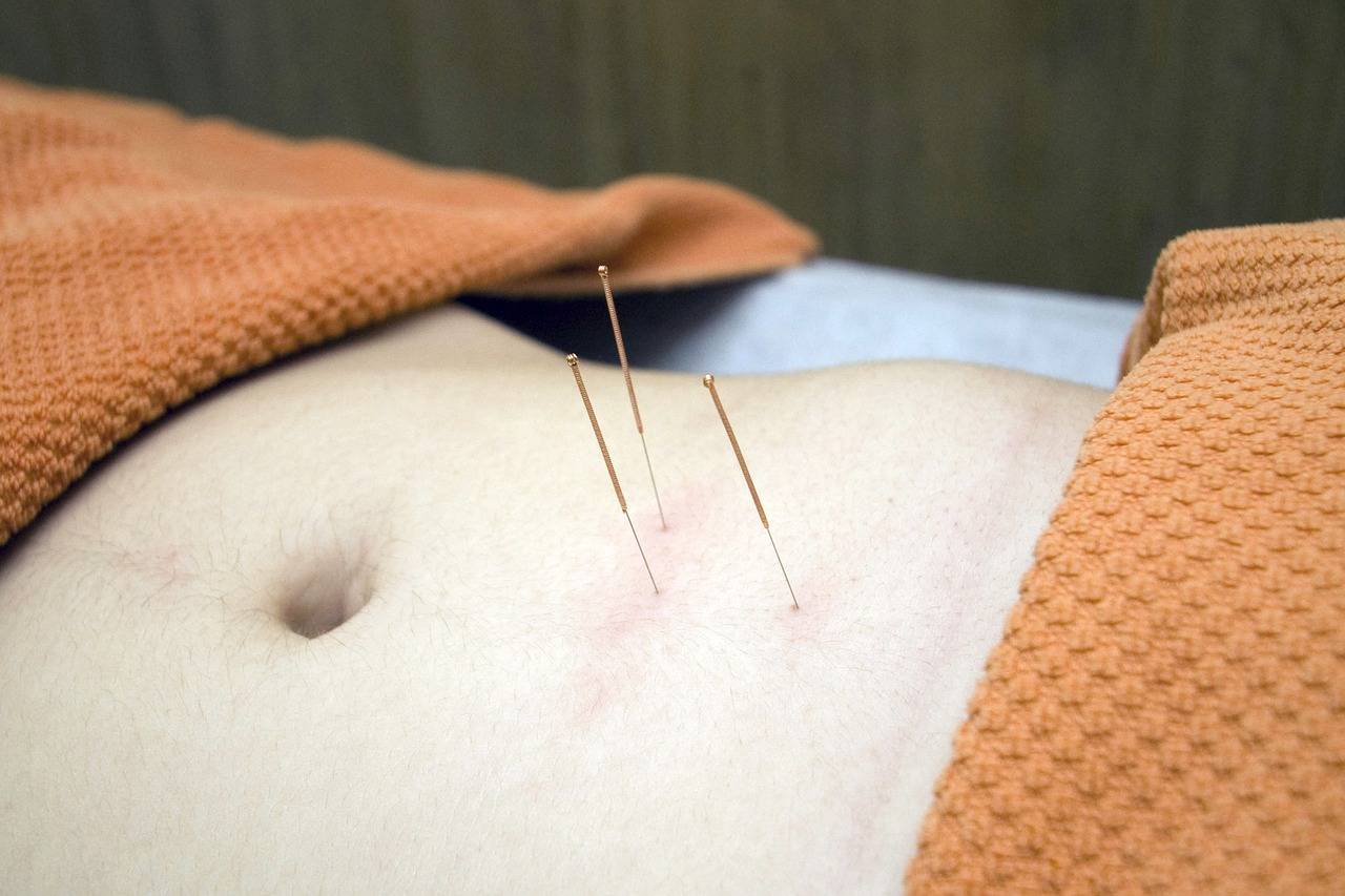 agopuntura