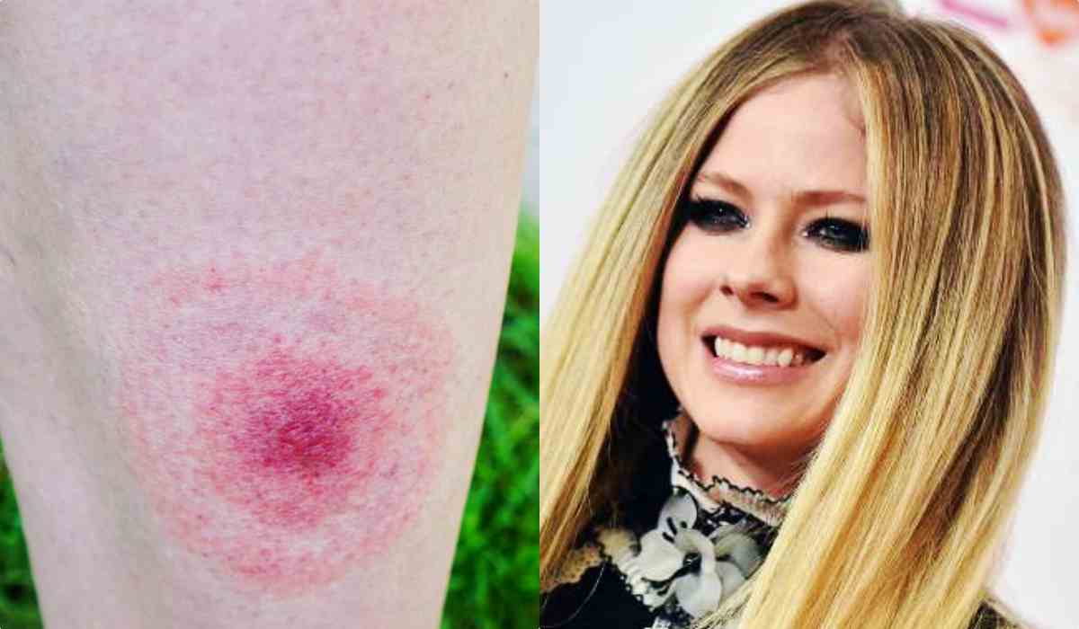 Avril Lavigne, come diagnosticare la sua malattia