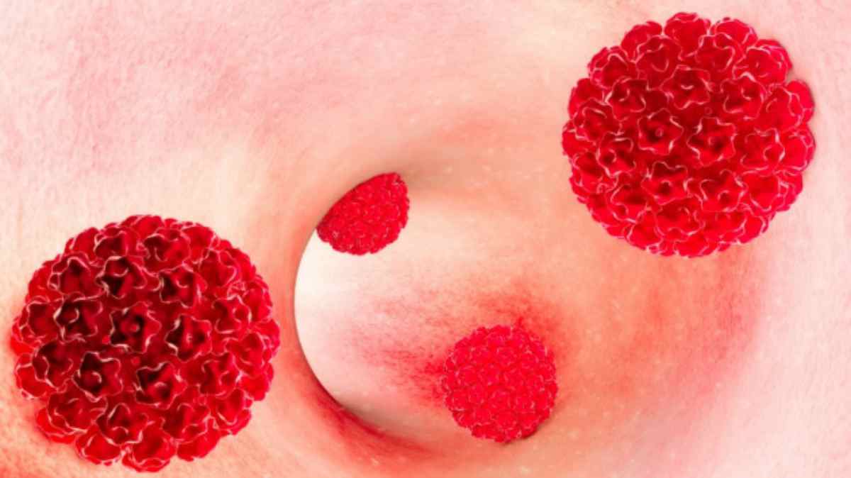 Papilloma virus o tumore Cancerul oral: ce este, diagnostic, tratament