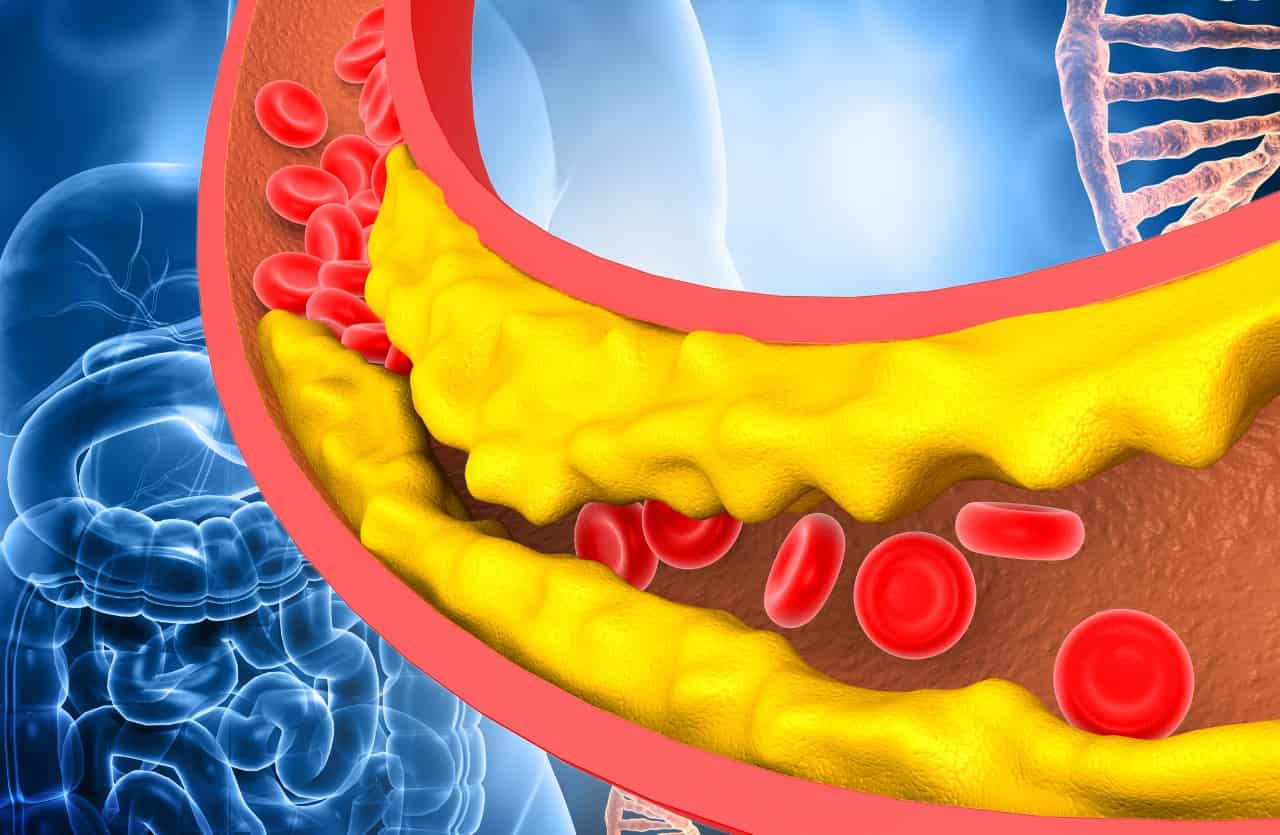 Cholesterol and blood sugar, clogged arteries