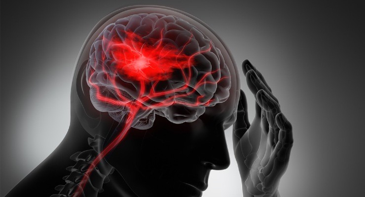 ictus cerebrale